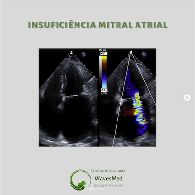  Insuficiência Mitral Atrial Wavesmed