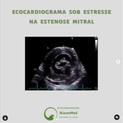 Eco sob Estresse na Estenose Mitral Wavesmed