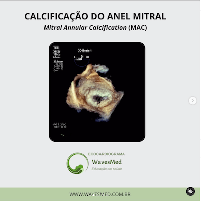 MAC = Mitral Annular Calcification Calcificação anular mitral Wavesmed