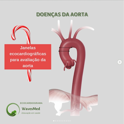 Janelas ecocardiográficas para avaliação da aorta Wavesmed