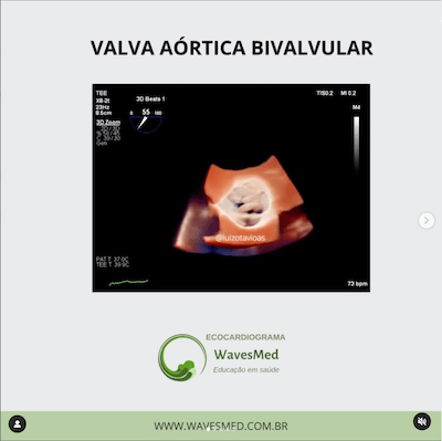 Valva aórtica bivalvular Wavesmed