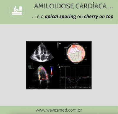 Amiloidose Cardíaca Wavesmed