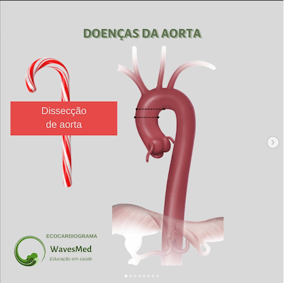 Dissecção de aorta Wavesmed