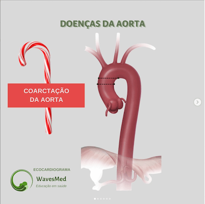 Coarctação de aorta