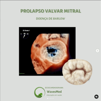 Prolapso Valva rmitral Wavesmed