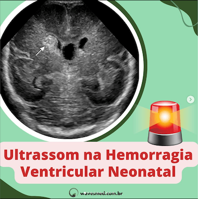 USG na hemorragia intracraniana Wavesmed