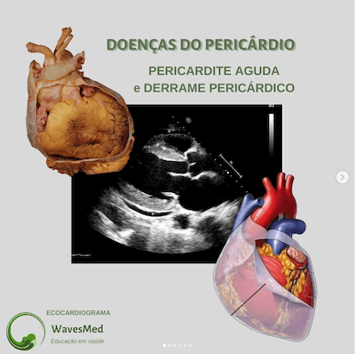 PERICARDITE AGUDA E DERRAME PERICÁRDICO