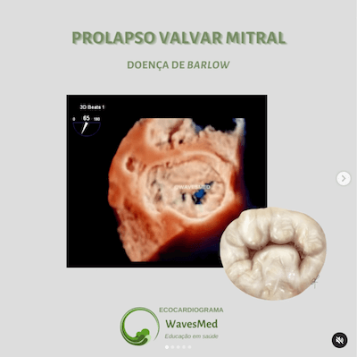 Prolapso da Valva mitral e doença de Barlow