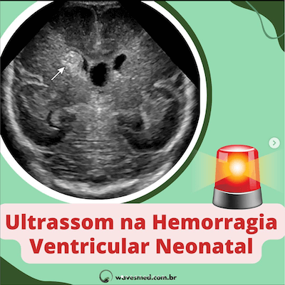 ULTRASSOM NA HEMORRAGIA VENTRICULAR NEONATAL WAVESMED