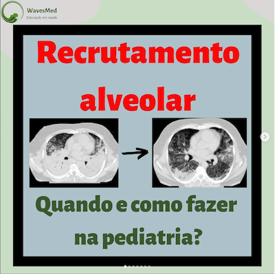 RECRUTAMENTO ALVEOLAR WAVESMED