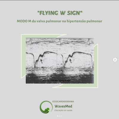 Flying W sign – Modo M da valva pulmonar na hipertensão pulmonar severa