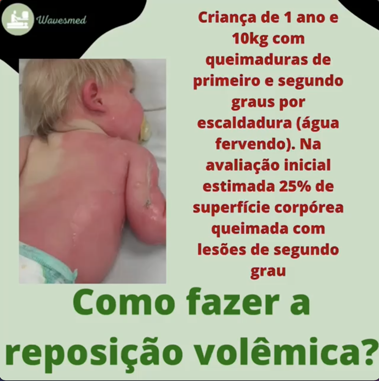 Como fazer reposição volêmica no grande queimado?