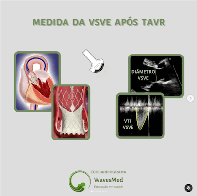 MEDIDA DA VSVE APÓS TAVR ECOCARDIOGRAMA