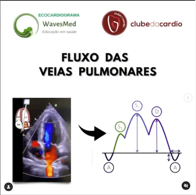 AVALIAÇÃO DAS VEIAS PULMONARES PELO ECOCARDIOGRAMA WAVESMED