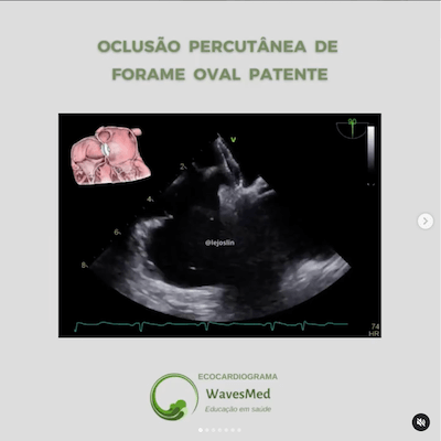 PASSO A PASSO DA OCLUSÃO PERCUTÂNEA DE FORAME OVAL PATENTE