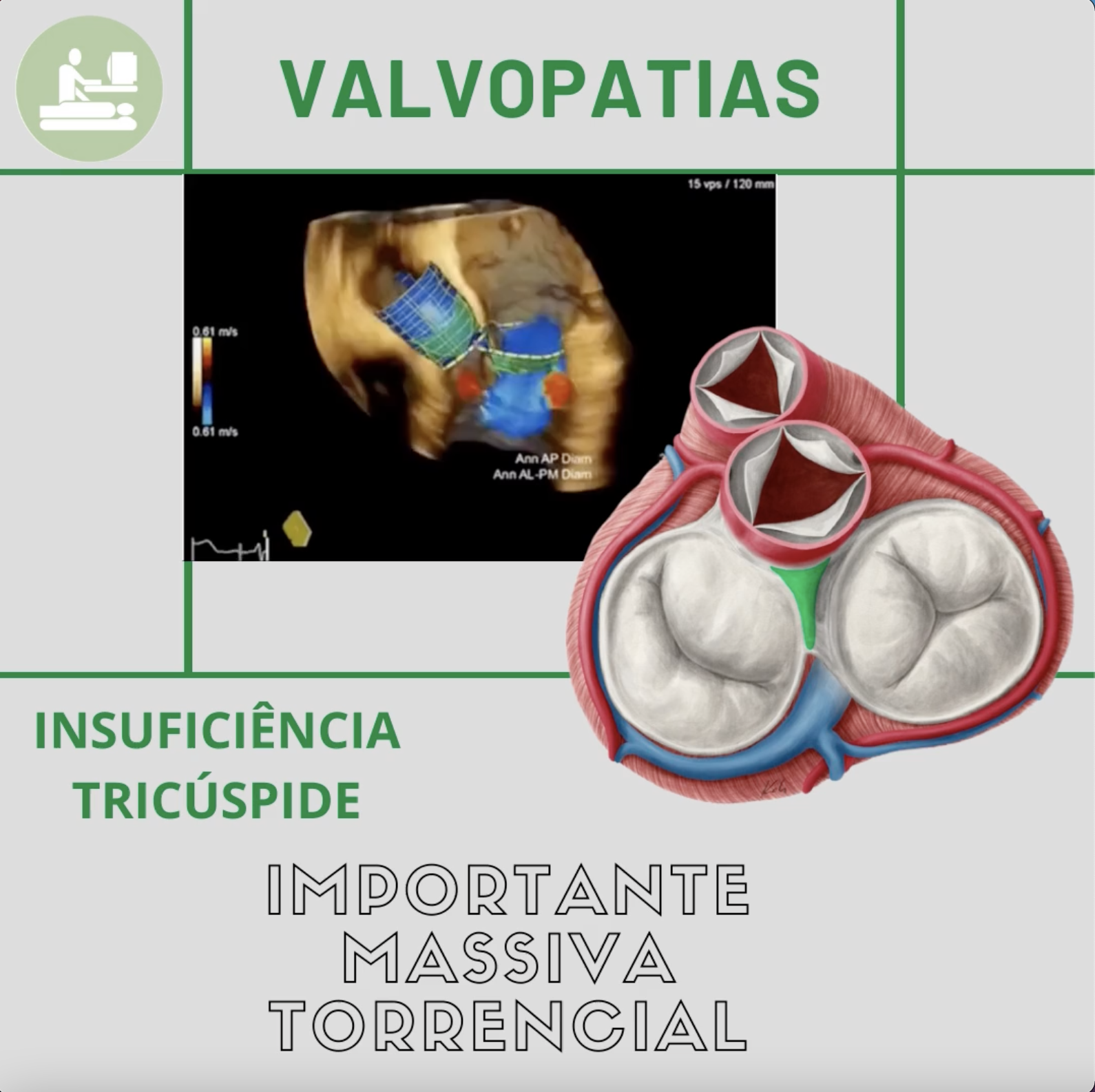 Insuficiência tricúspide massiva torrencial