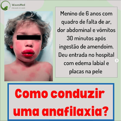 COMO CONDUZIR ANAFILAXIA?