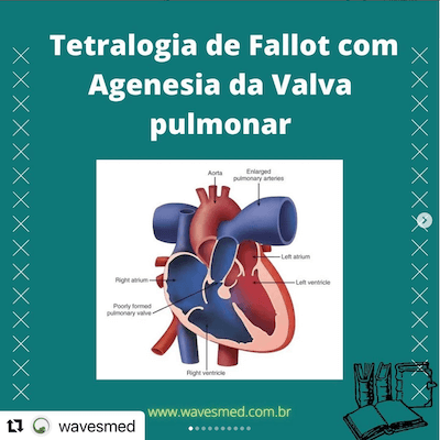 TETRALOGIA DE FALLOT COM AGENESIA DA VALVA PULMONAR