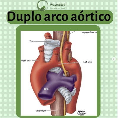 Duplo arco aórtico