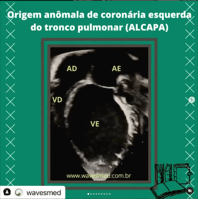 Origem anômala da coronária esquerda (ALCAPA) 