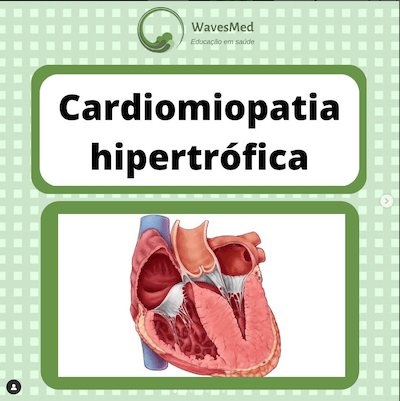 Miocardiopatia hipertrófica