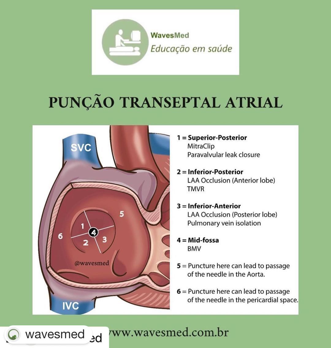 Punção septal atrial