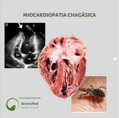 Ecocardiograma na doença de Chagas