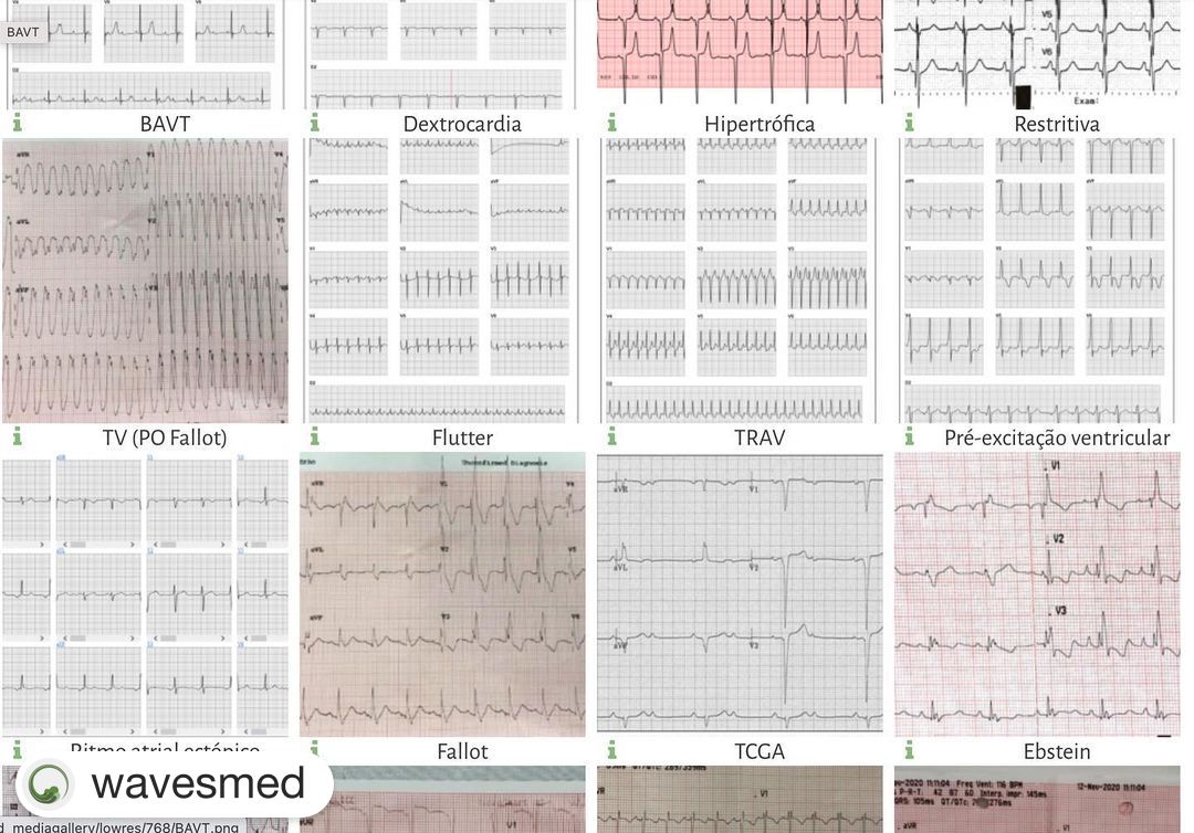 Banco de ECG com diagnósticos em cardiopatia congênita