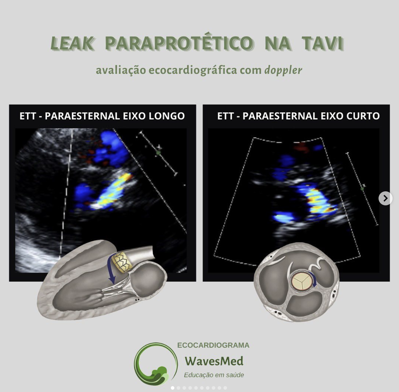 Leak Paraprotético na TAVI Wavesmed