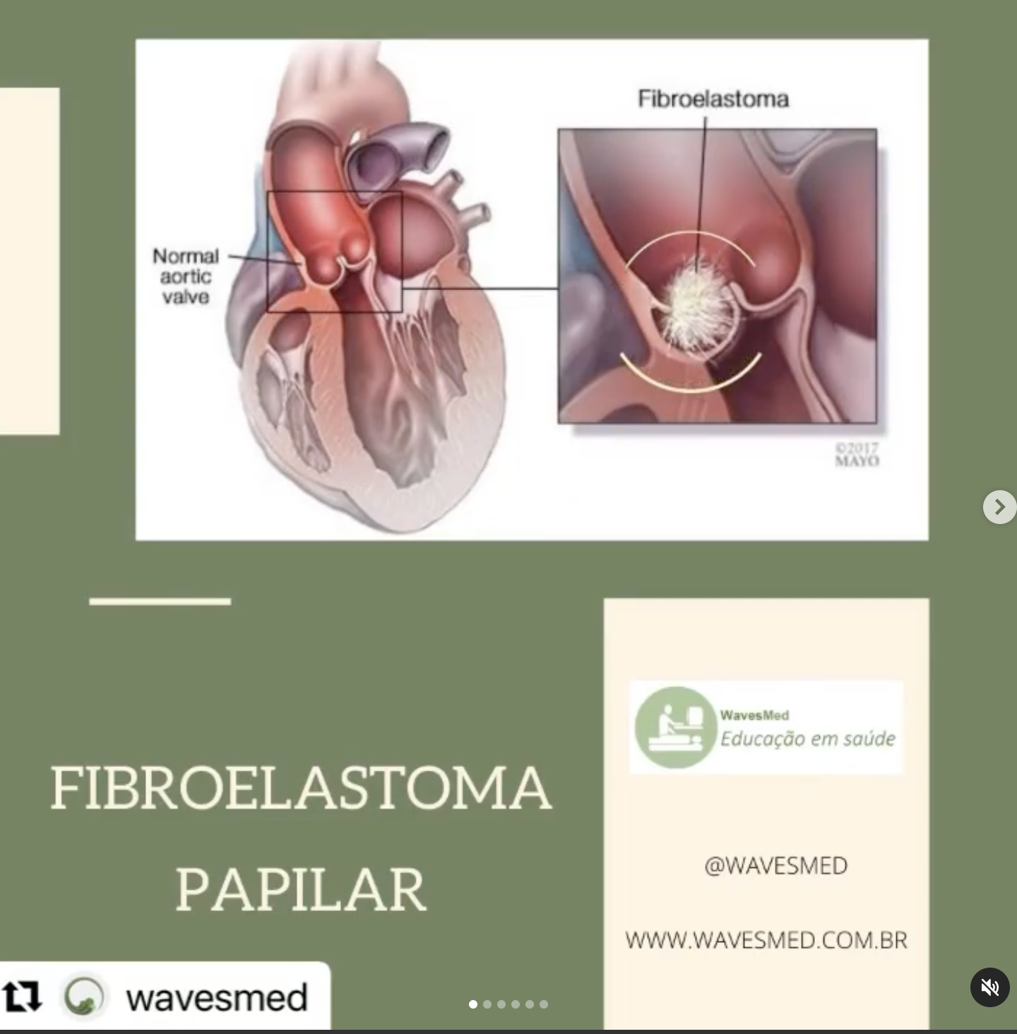 Ecocardiograma - Fibroelastoma papilar