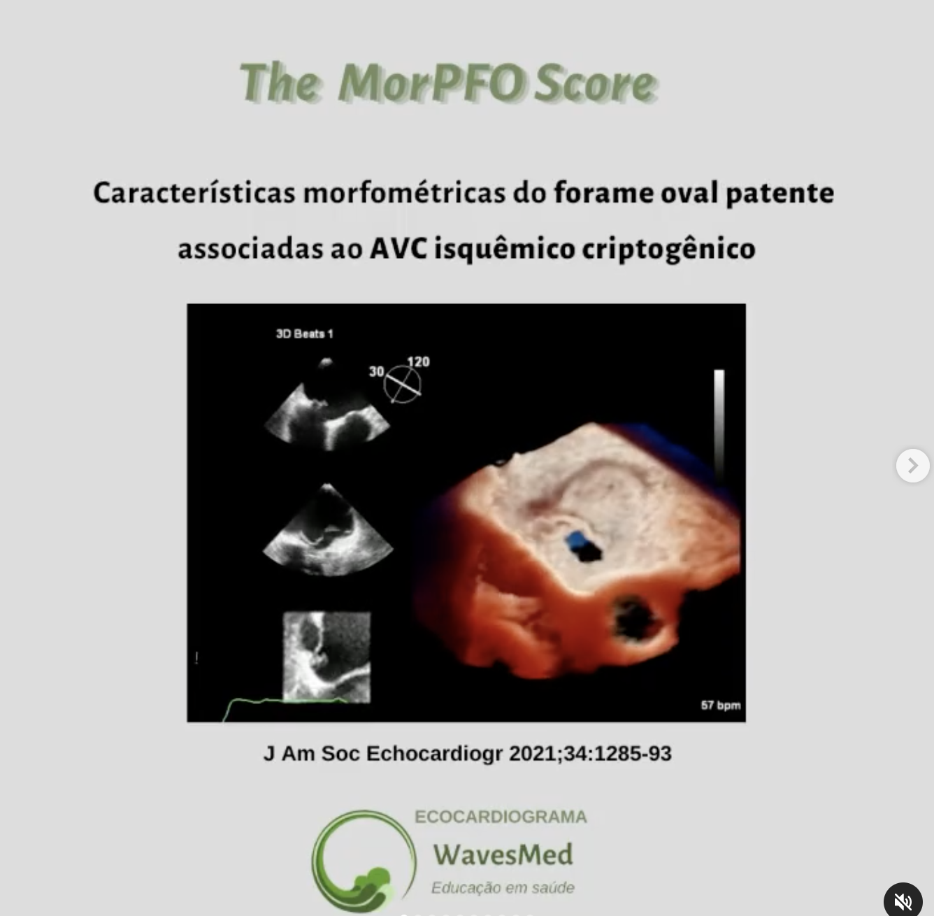 Características morfométricas do forame oval patente associadas a AVC criptogênico