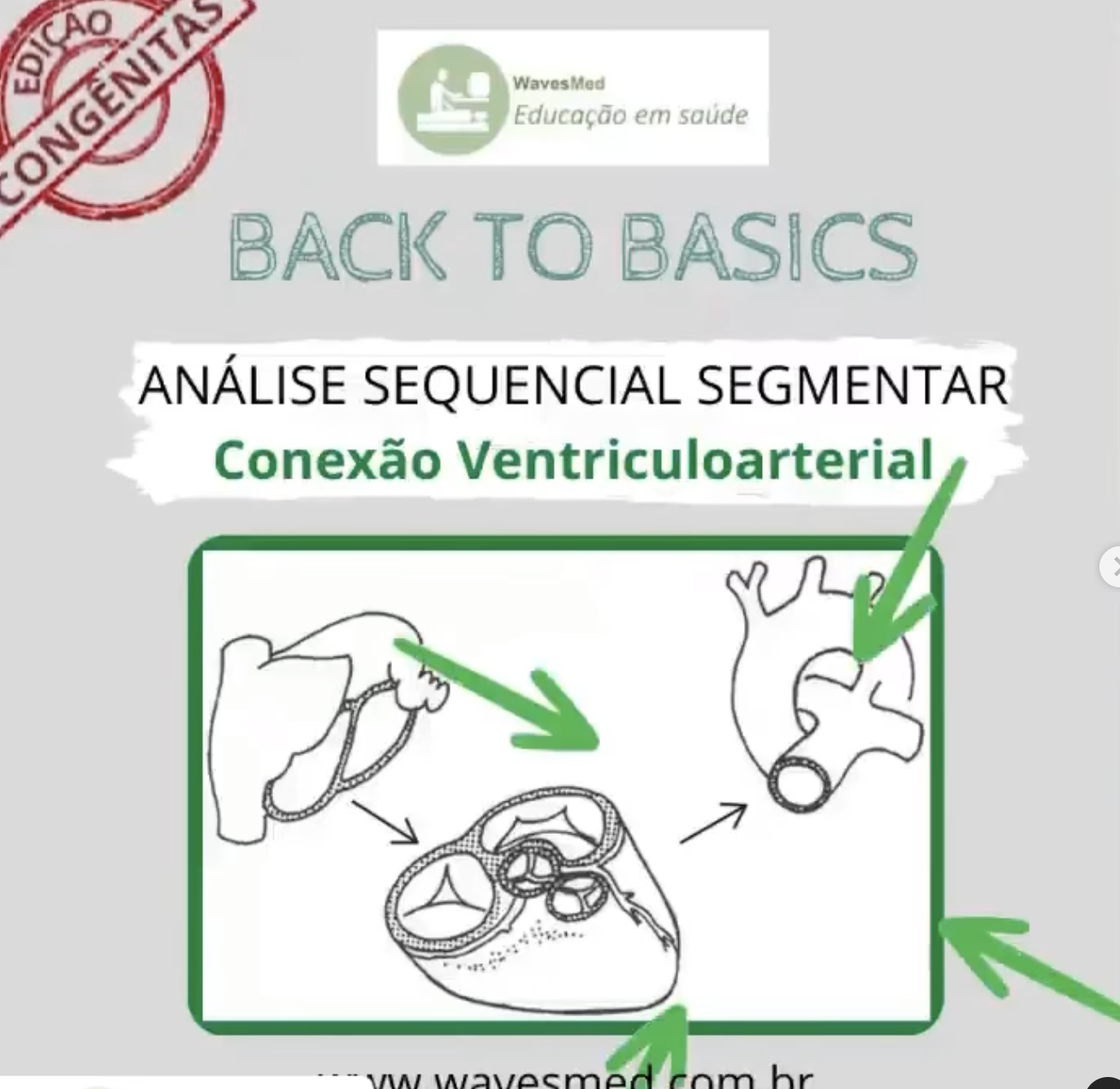 Conexão Ventriculoarterial, você sabe diferenciar?