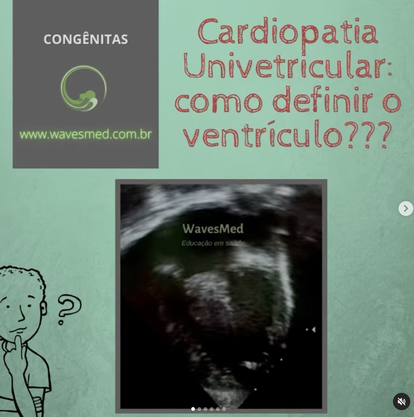 Cardiopatia congênita univentricular: Como definir os ventrículos?