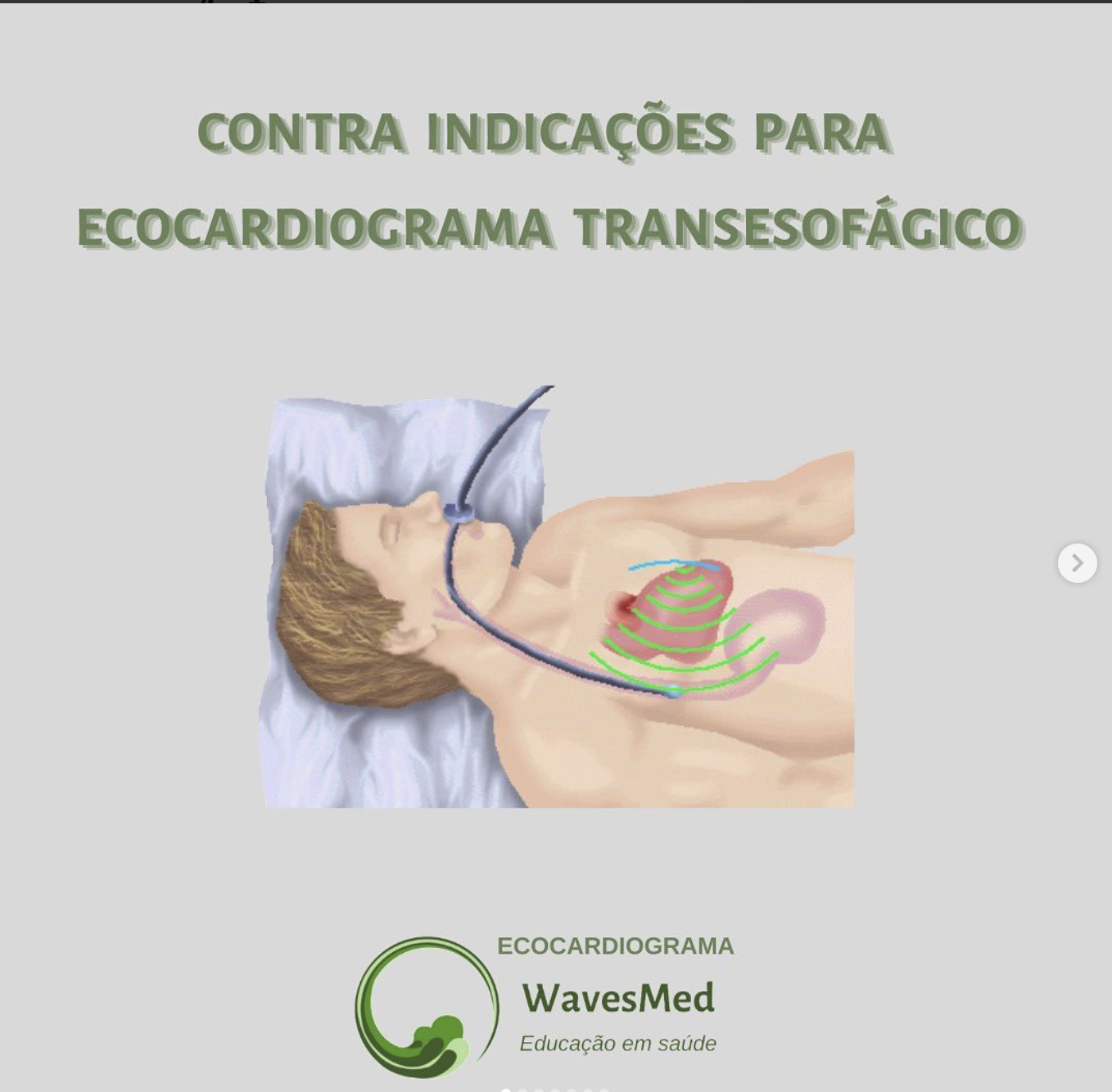 Ecocardiograma: o eco transesofágico (ETE)