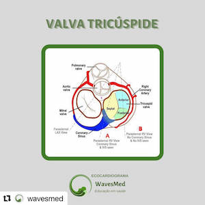 Você consegue identificar as cúspides da valva tricúspide ao ecocardiograma transtorácico?