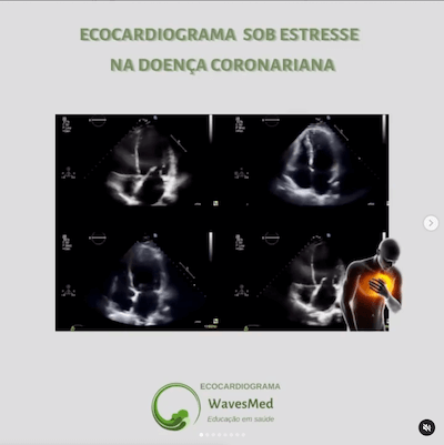 Ecocardiografia sob estresse Wavesmed