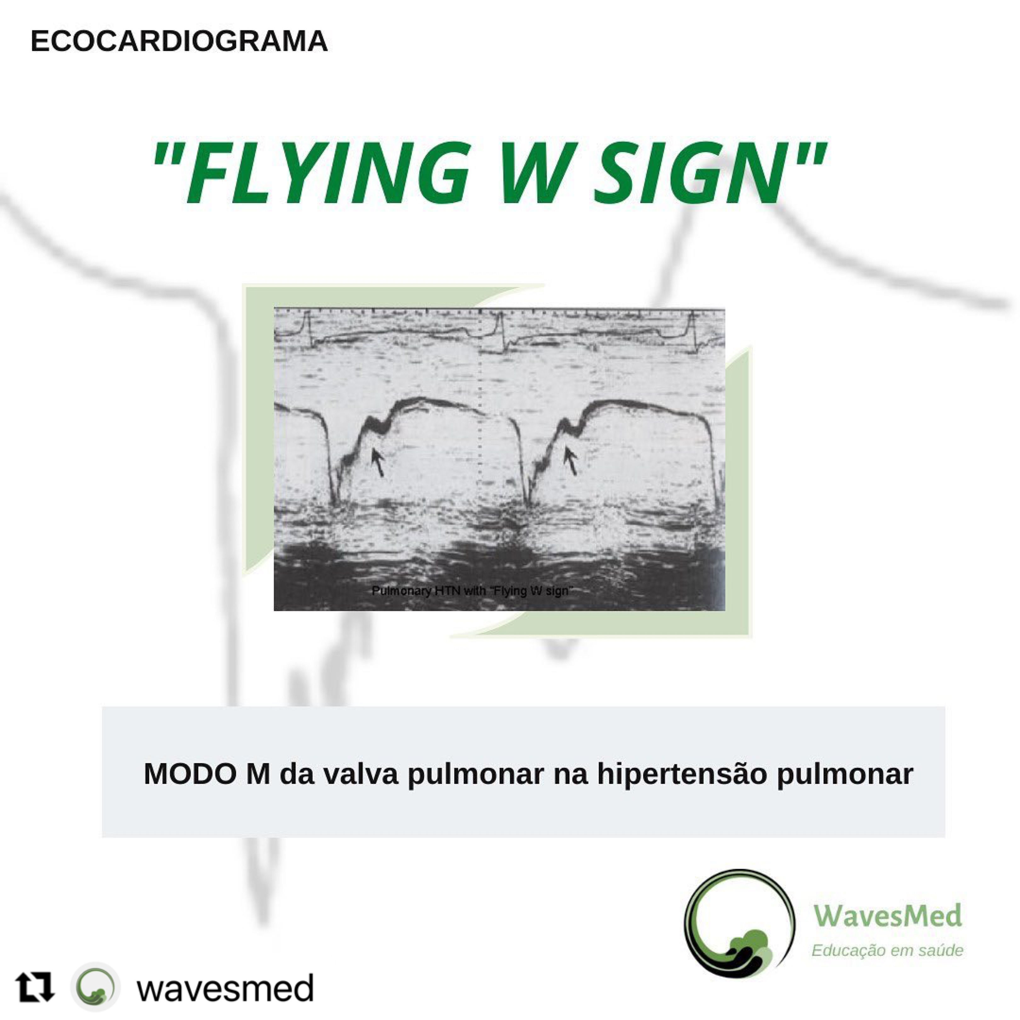  Flying W sign – Modo M da valva pulmonar na hipertensão pulmonar severa