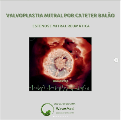 Valvoplastia mitral por cateter balão