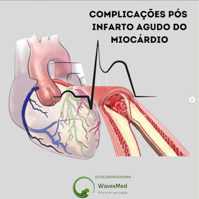 Ecocardiograma no infarto agudo do miocárdio Wavesmed