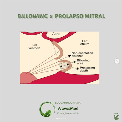 Ecocardiograma Billowing Mitral