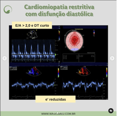 Relação e a função diastólica cardiomiopatia restritiva wavesmed