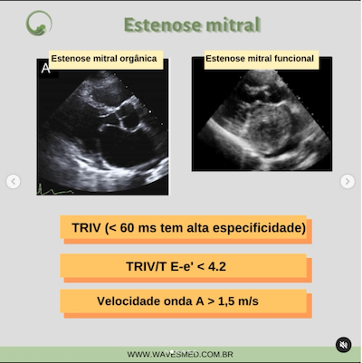 Estenose mitral função diastólica nas valvopatias wavesmed