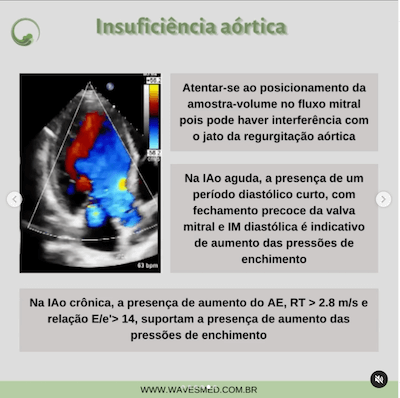 insuficiência aórtica função diastólica nas valvopatias wavesmed