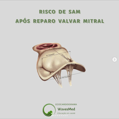 Risco de sam após reparo valvar mitral wavesmed