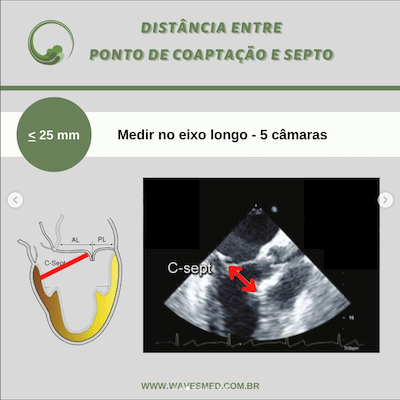 Distancia ponto captação septo risco de sam após reparo valvar mitral wavesmed