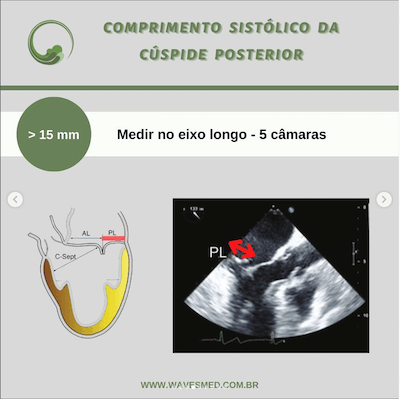 Comprimento sistólico da cúspide posterior risco de sam após reparo valvar mitral wavesmed