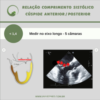 Relação cúspide anterior posterior risco de sam após reparo valvar mitral wavesmed