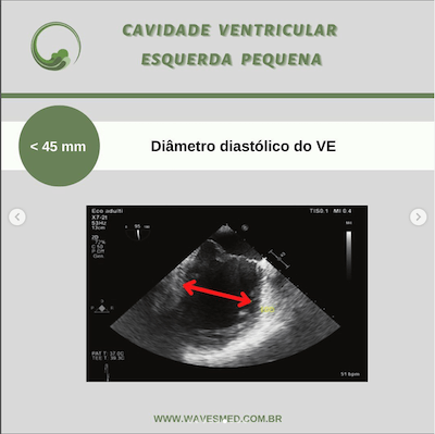 Cavidade ventricular esquerda risco de sam após reparo valvar mitral wavesmed