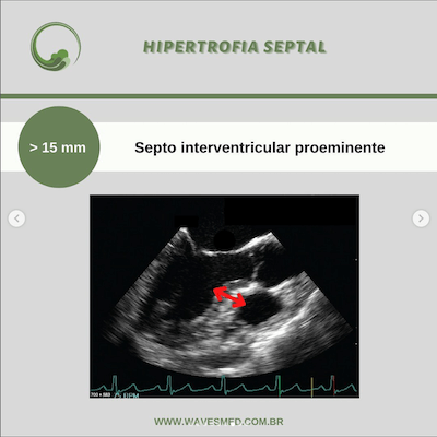 Hipertrofia septal risco de sam após reparo valvar mitral wavesmed