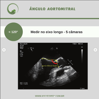 Ângulo aortomitral risco de sam após reparo valvar mitral wavesmed